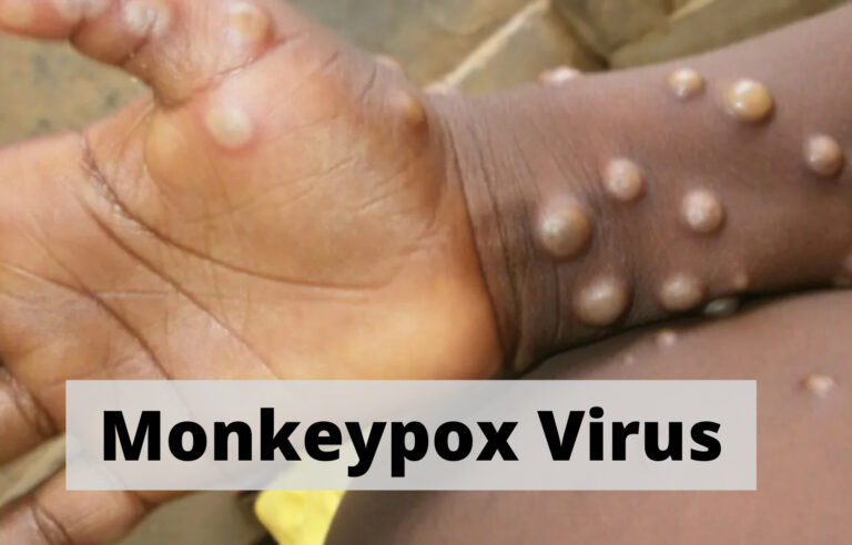 No Monkey pox in Malawi
